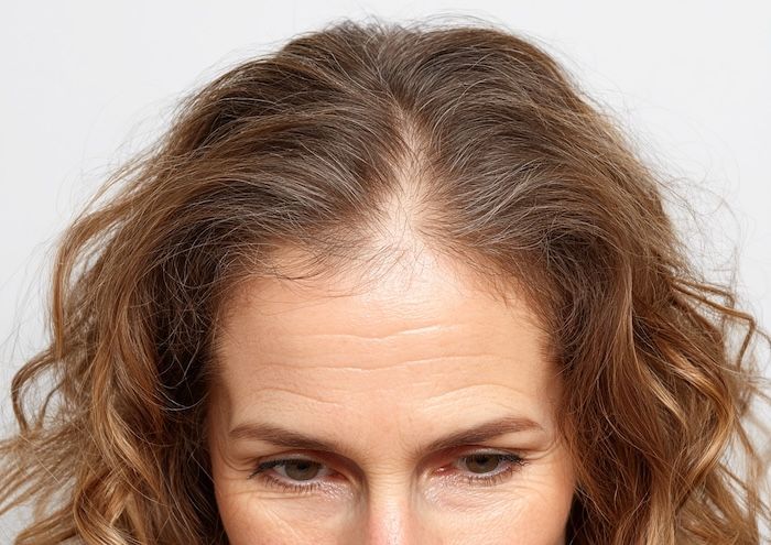 Alopecia areata