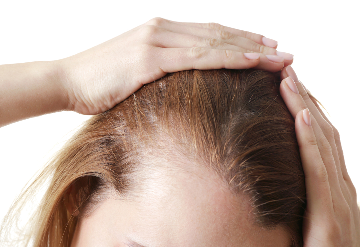 Alopecia areata