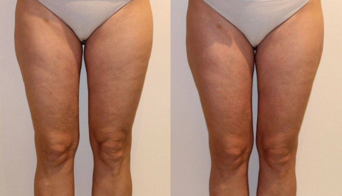 How to do anti-cellulite massage