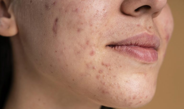 What is post-acne