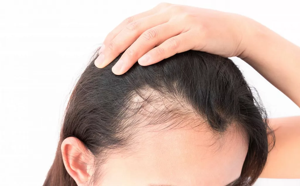 Androgenetic alopecia
