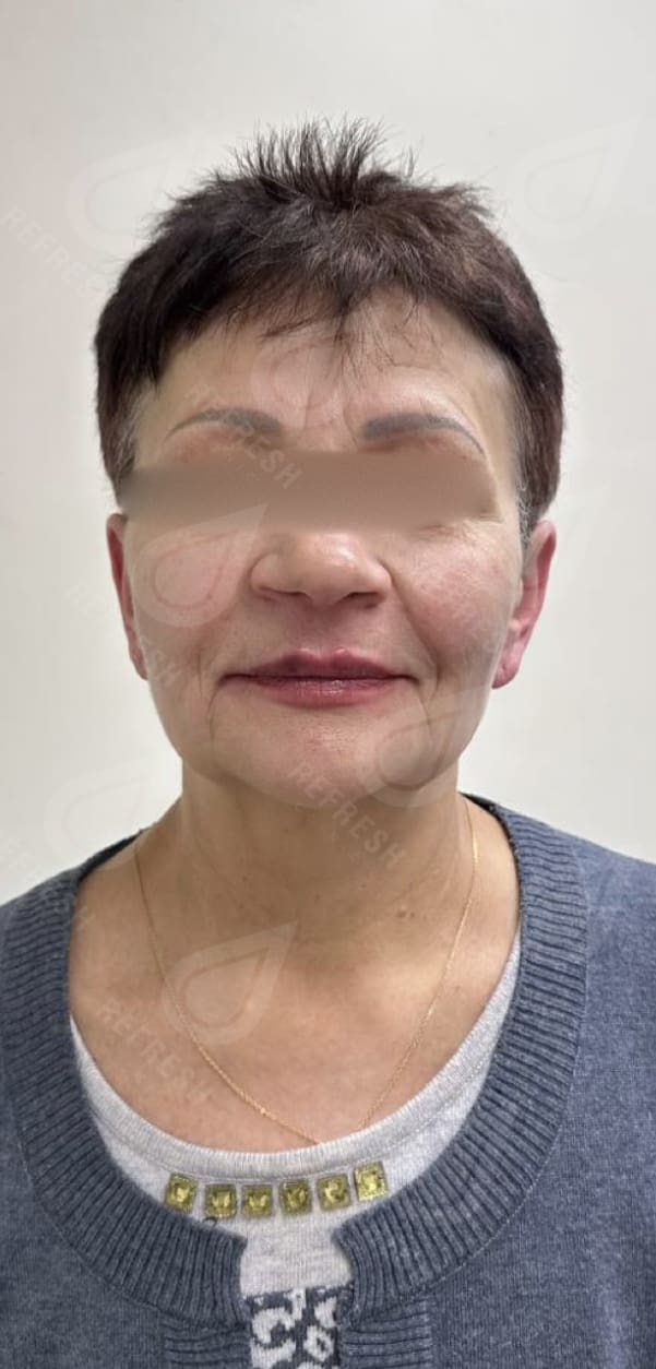 Ultraformer