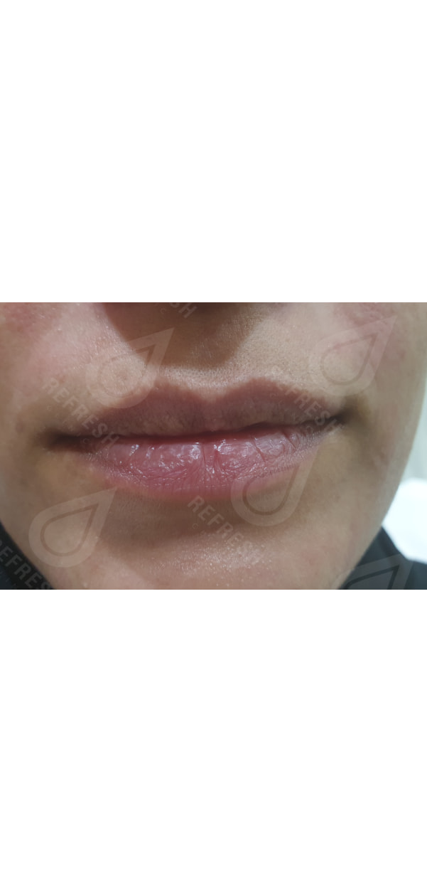 Facial Contouring with Dermal Fillers
