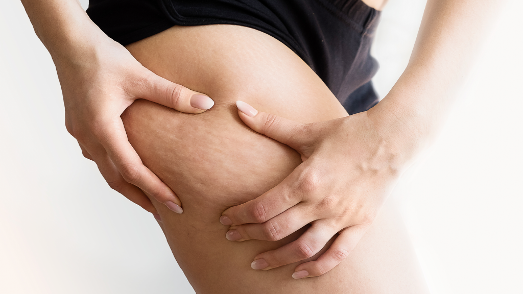 Best cellulite reduction treatments in Dubai