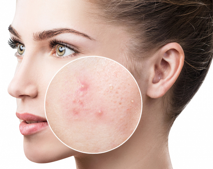 What is acne