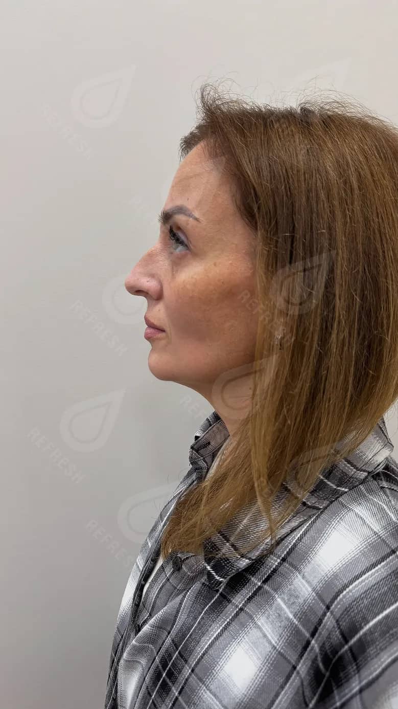 Ultraformer