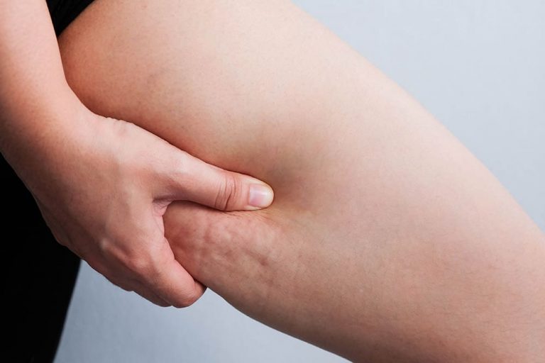 How to get rid of cellulite