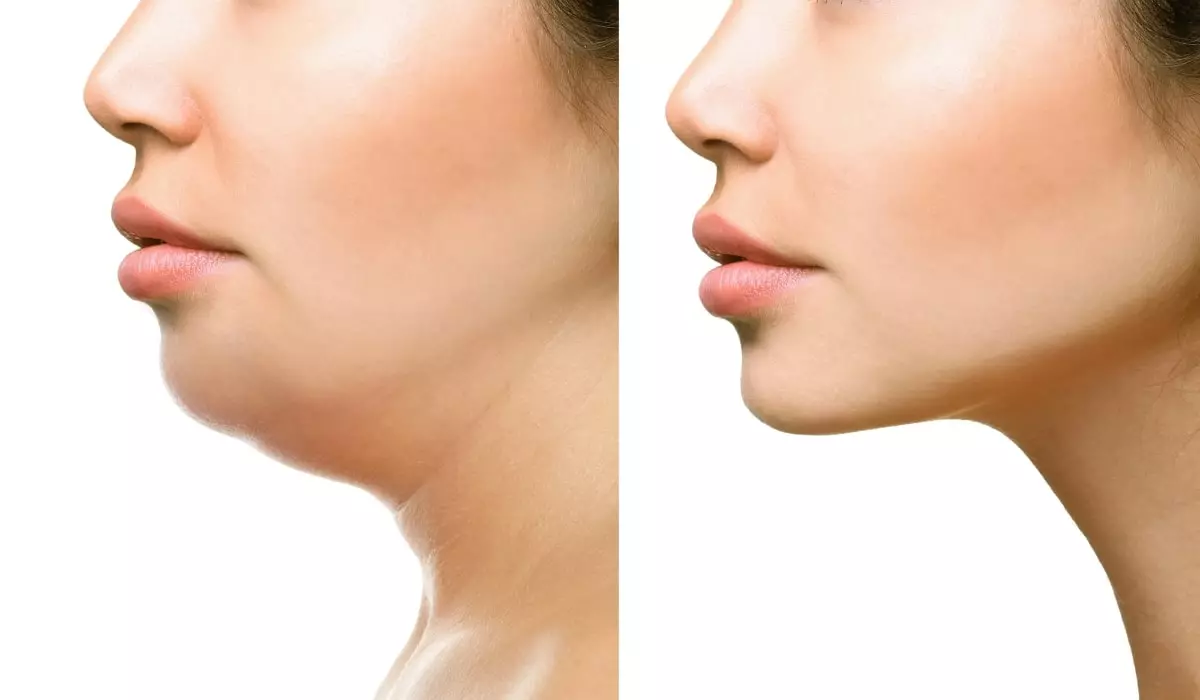 Fat-dissolving injections for the jawline — how lipolysis refines the lower-face profile