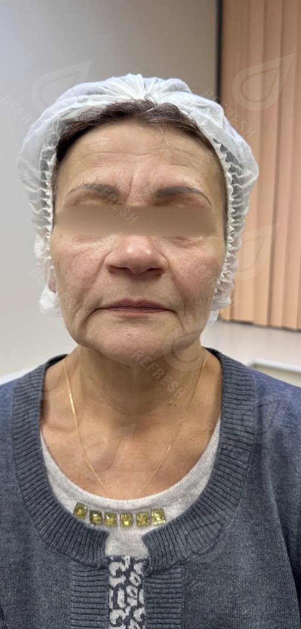 Ultraformer