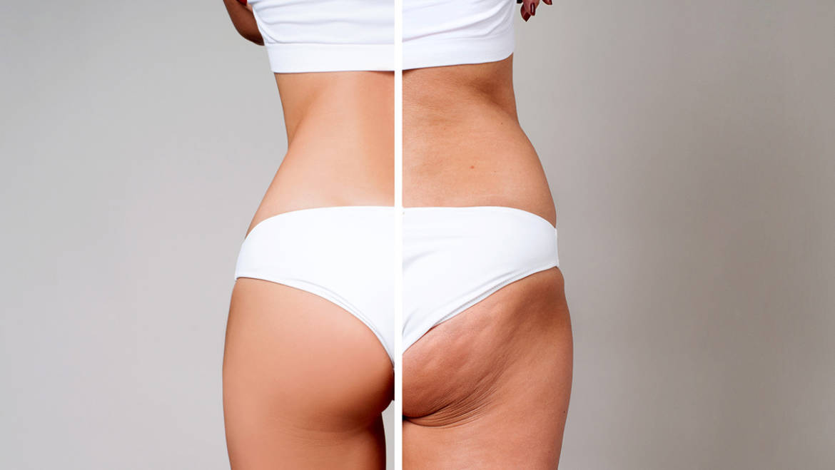 How to get rid of cellulite
