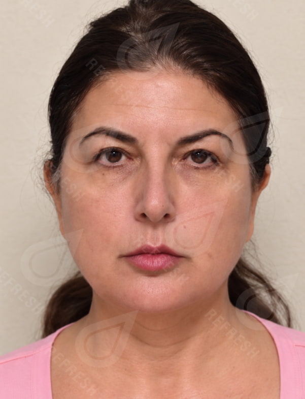 Collagen Biostimulator