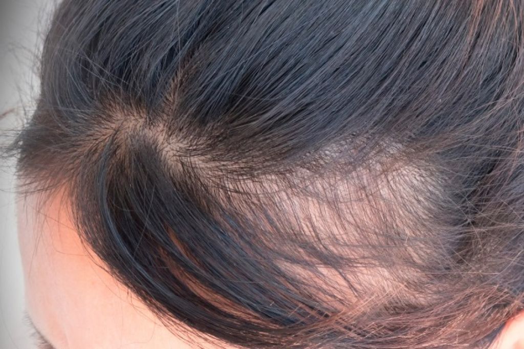 Androgenetic alopecia