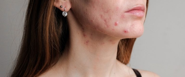 What is post-acne