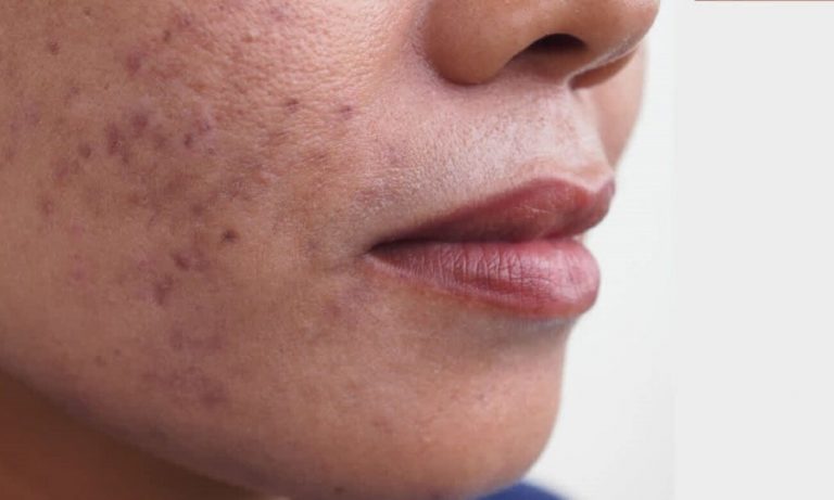 What is post-acne