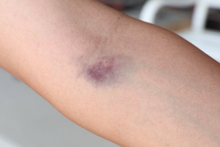 Why does a vein hurt after an IV drip?
