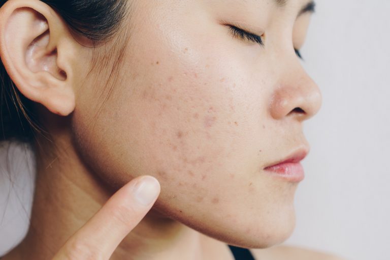 What is post-acne