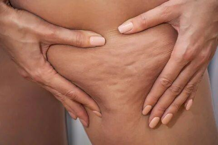 How hormonal changes affect skin quality and the development of cellulite