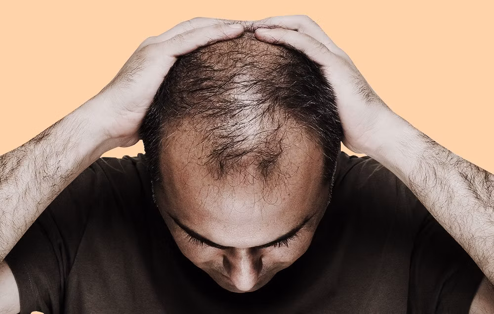 Androgenetic alopecia
