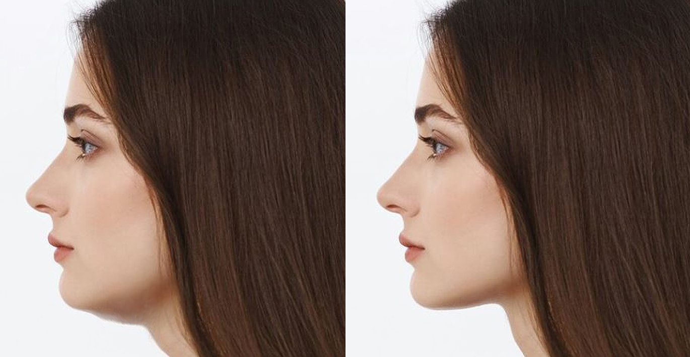 Lipolysis combined with RF lifting — a synergy that enhances contouring results