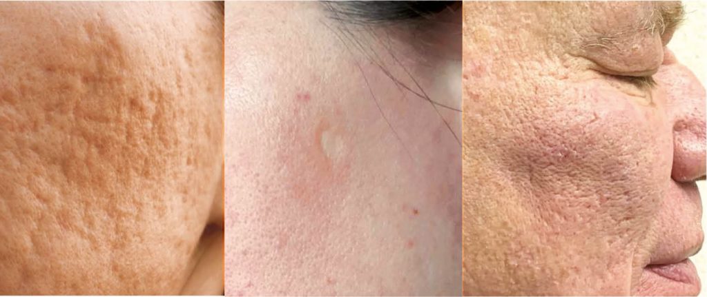 What is post-acne