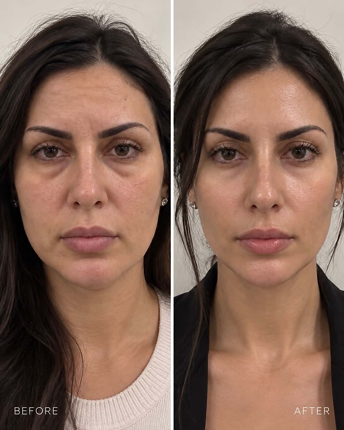 Face Lipolysis Treatment 