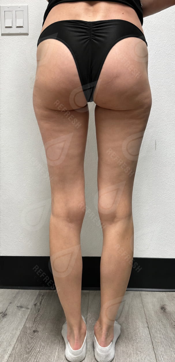 Icoone Laser 2