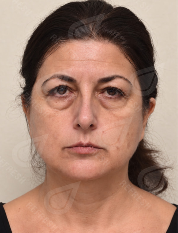 Collagen Biostimulator