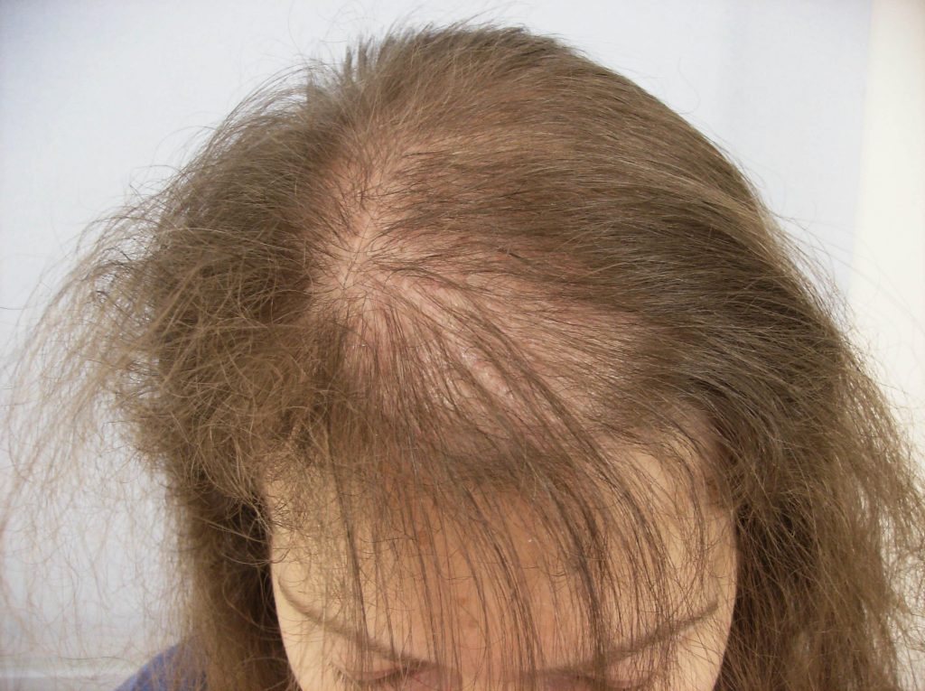 Alopecia areata