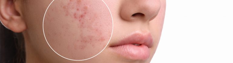 What is acne
