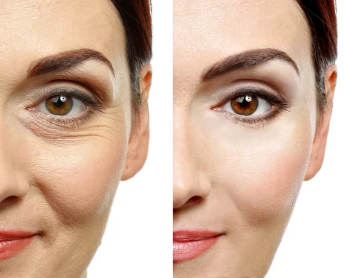 Baby Botox vs Classic Botox — choosing the most natural-looking result
