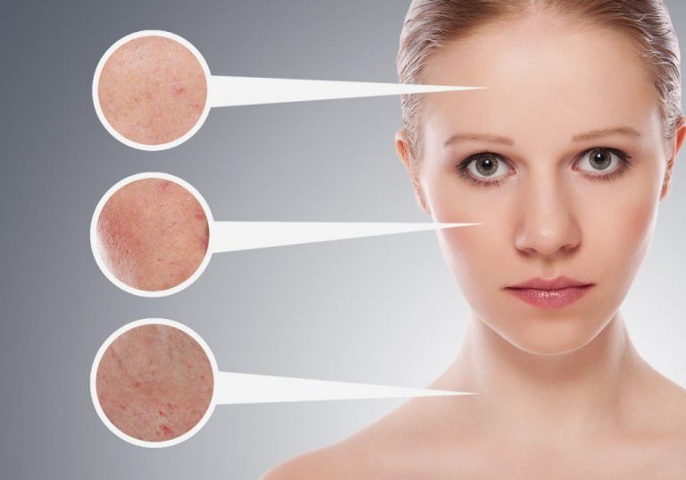 What is acne