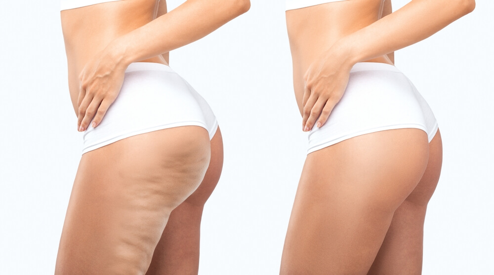 How hormonal changes affect skin quality and the development of cellulite