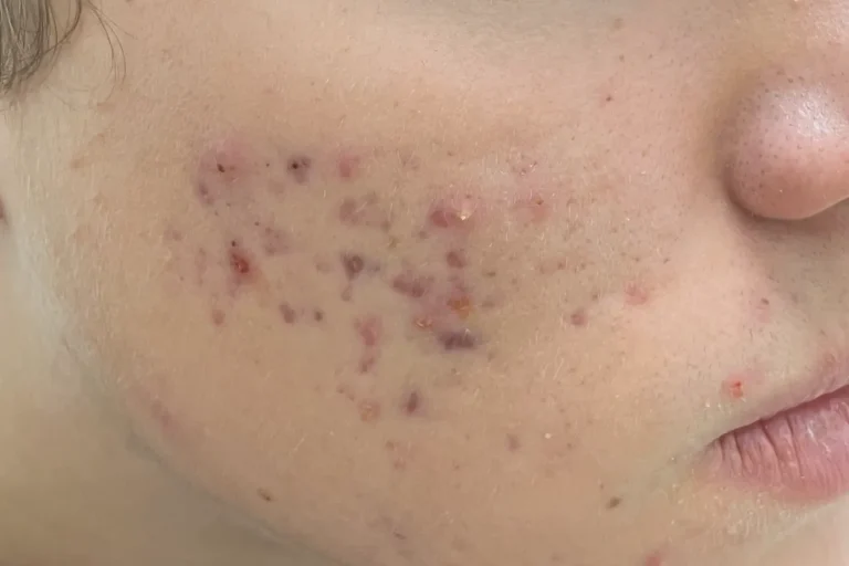 What is acne