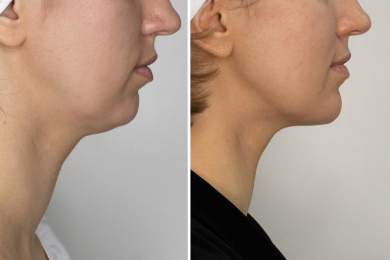 How to get rid of a double chin