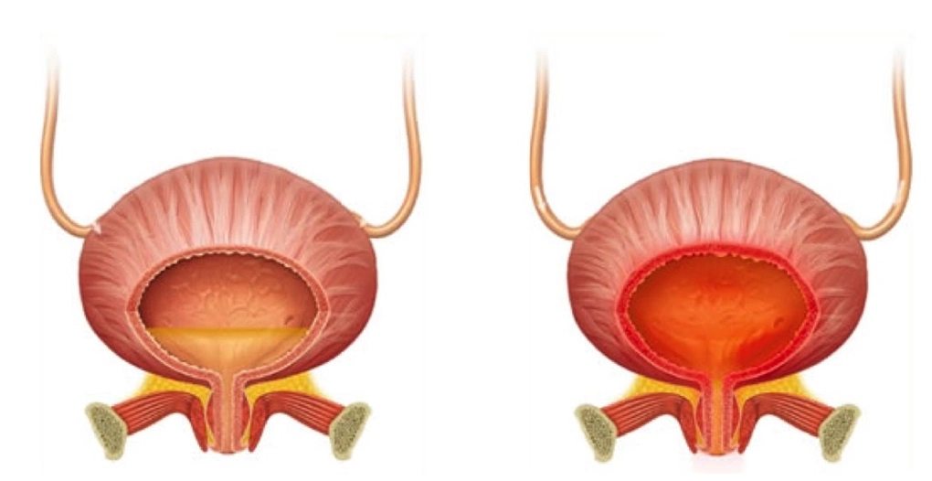 What tests should be done for cystitis