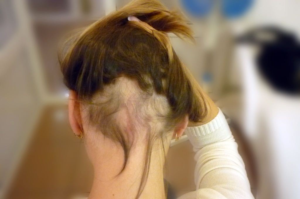 Alopecia areata