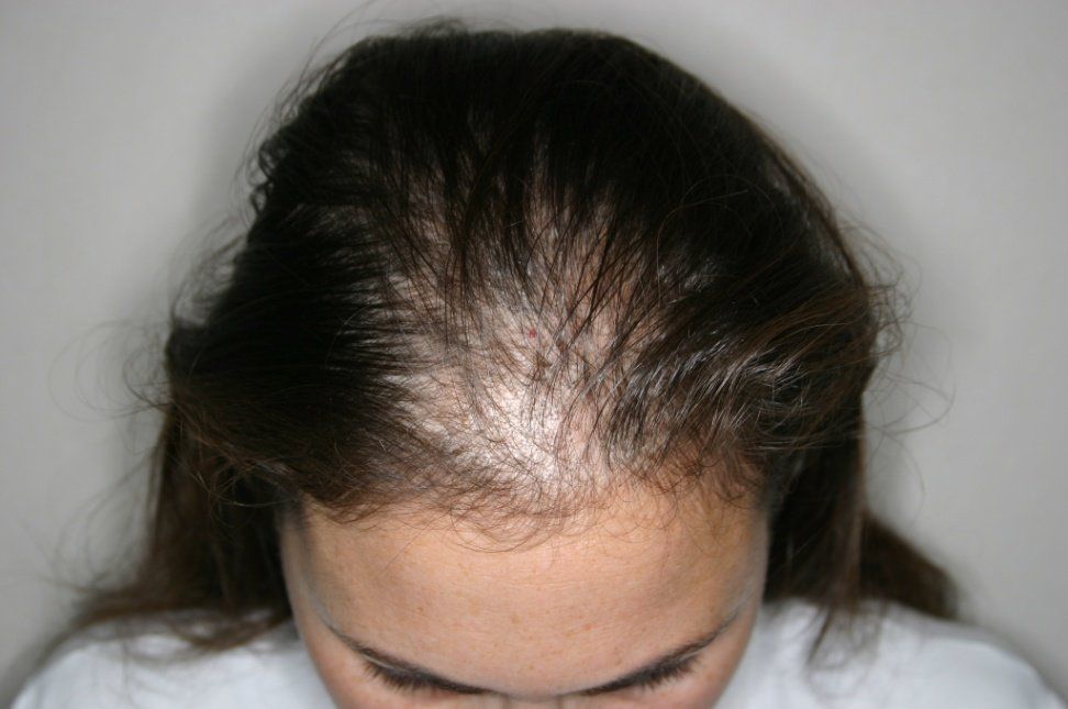 Androgenetic alopecia