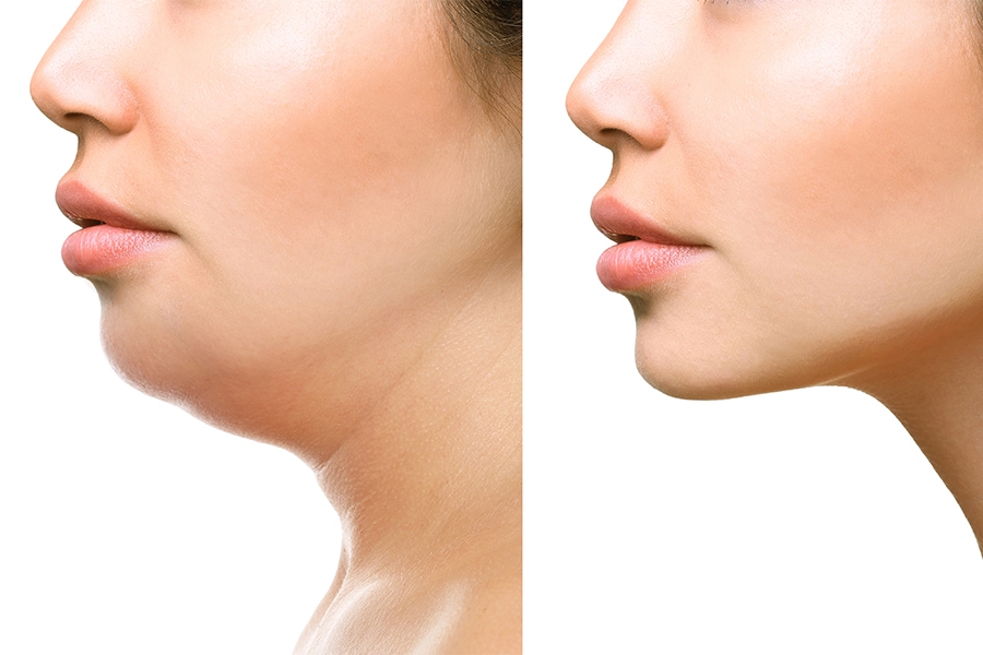 How to get rid of a double chin