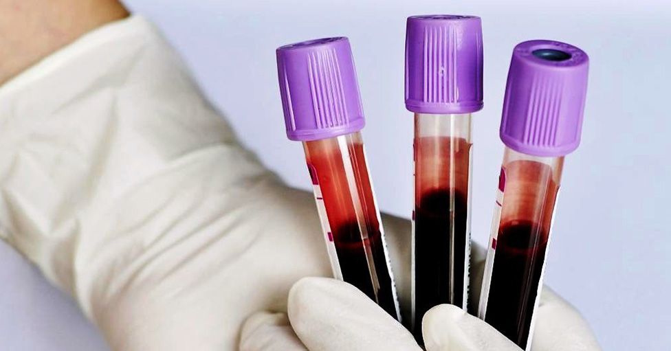 Female hormone tests: when to take them?
