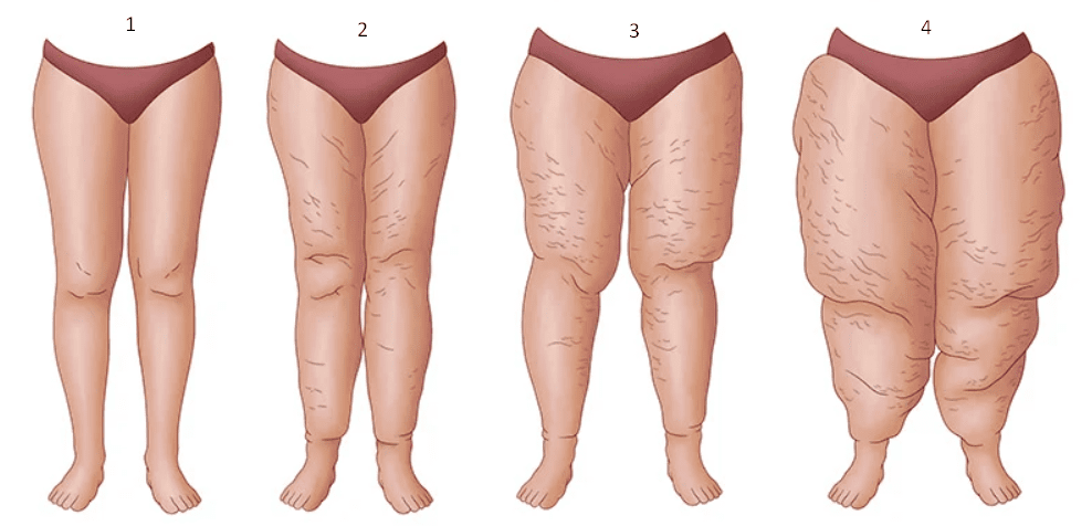 How hormonal changes affect skin quality and the development of cellulite