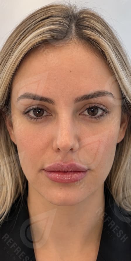 baby-botox
