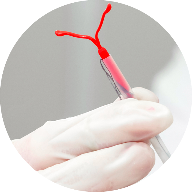 Intrauterine Device (IUD) Insertion