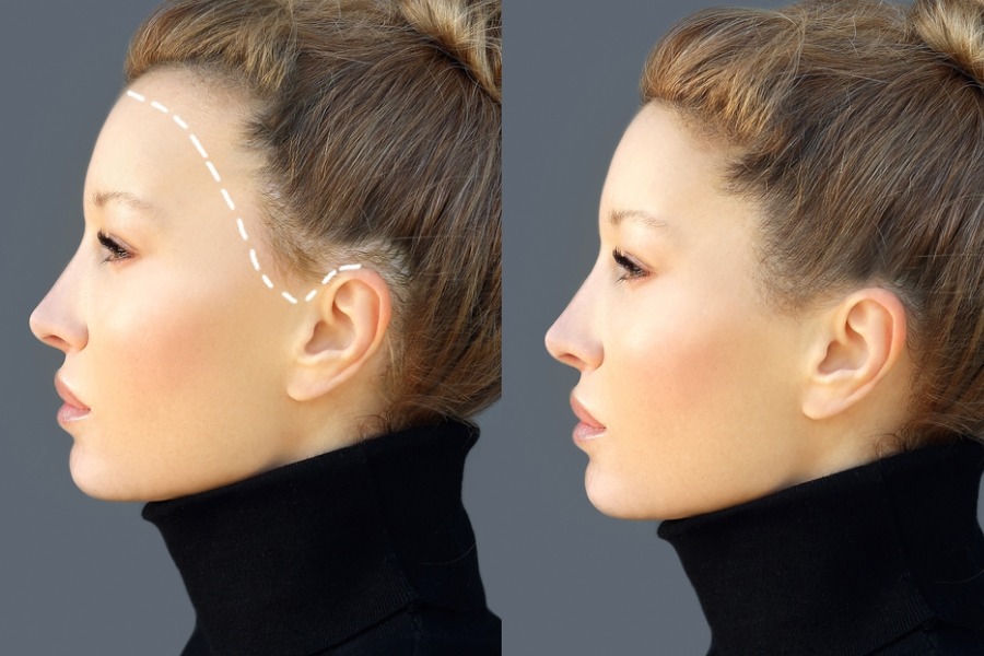 Alopecia areata